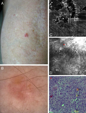 Correlation of clinical, dermoscopic, and reflectance confocal microscopy (RCM) images of Bowen's disease. (A) Clinical image showing a single small erythematous plaque on the forearm in a kidney transplant patient. (B) Dermoscopic examination reveals the presence of glomerular vessels and areas of erosion. (C) RCM mosaic illustrates correlation between erosion and superficial disruption and crusting seen as deposits of low refractile amorphous material (white arrowheads). (D) RCM single images obtained at the level of the stratum spinosum showing complete architectural disruption with atypical honeycomb pattern and broadened honeycomb pattern (black asterisk). Single large cells with bright centers can be observed (red arrowhead), probably corresponding to dyskeratotic cells. Also visualized are small round bright structures that correspond to inflammatory cells. The dilated round-to-oval blood vessels are the RCM equivalent of the glomerular vessels seen on dermoscopy. (E) Corresponding hematoxylin–eosin histology showing marked keratinocyte atypia with large atypical cells, multinucleated cells (white arrowhead) and dyskeratotic cells (red arrowhead). Keratin pearls (white dashed circle) and dilated blood vessels are also visualized.