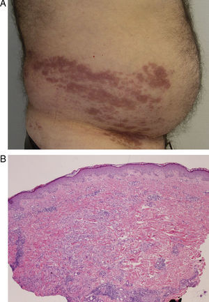 Caso 2: A. placas eritemato-marronáceas en flanco derecho, que confluyen sobre el dermatomo T10. B. dermatitis perivascular e intersticial linfohistiocitaria (hematoxilina-eosina x10).