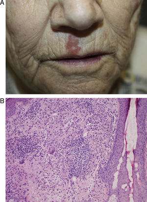 Caso 3:A. placa eritematosa, levemente infiltrada y con superficie rugosa, localizada en el labio superior derecho. B. infiltrado granulomatoso en la dermis superficial, constituido por una proliferación histiocitaria y células gigantes multinucleadas, que forman granulomas laxos no bien conformados (hematoxilina-eosina x10).
