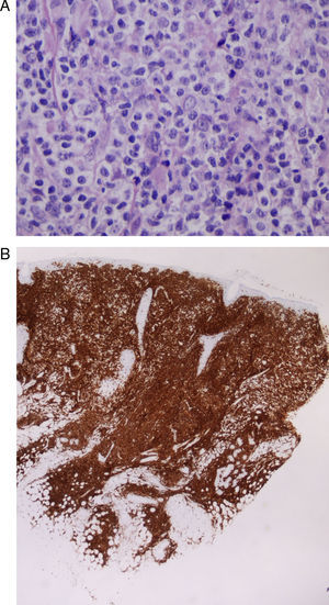 Caso 9: A. células de tamaño mediano-grande, de estirpe linfoide, con núcleos y nucléolos prominentes que presentan actividad mitótica (hematoxilina-eosina x20). B. infiltrado tumoral de crecimiento difuso en dermis, CD5 positivo, que se corresponde con infiltración específica cutánea de su LLC-B (marcador CD5, x4).