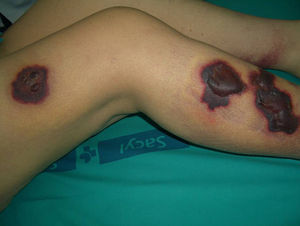 Cutaneous lesions on admission. Bullous erythematous violaceous plaques on the right leg.