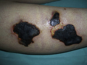 Cutaneous lesions on day 7 of hospitalization. Extensive cutaneous necrosis on the right leg.