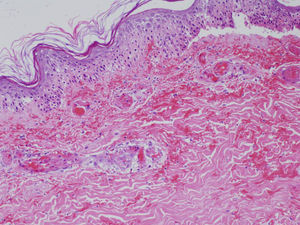 Skin biopsy. Extensive epidermal basal vasculopathy, hemorrhage throughout the dermis with organized thrombi in many dermal vessels and no evidence of vasculitis.