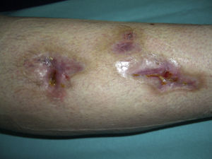 Cutaneous lesions after 3 months. Residual scarring visible on the leg.