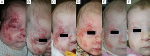 Caso 1. A. Hemangioma segmentario facial con oclusión ocular, antes de iniciar el tratamiento. B. A los 5 días se aprecia inicio de la apertura ocular. C. A los 12 días apertura casi completa y aclaramiento. D. A los 3 meses de tratamiento. E. A los 6 meses. F. A los 11 meses, un mes después de finalizar el tratamiento.