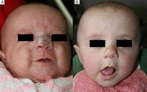 Caso 2. A. Hemangioma en punta nasal, antes de iniciar el tratamiento. B. Resultado final, tras 6 meses de tratamiento.