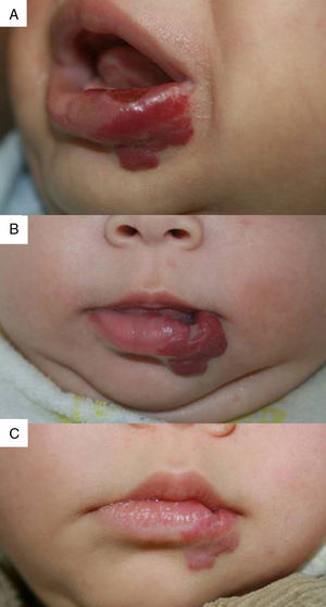 Caso 10. A. Hemangioma ulcerado en labio inferior. B. A los 2 meses de tratamiento con propranolol. C. A los 6 meses, aclaramiento y mínima cicatriz residual.