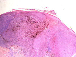 Histological features of a biopsied specimen of the parascapular lesion.