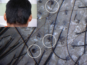 Placa alopécica descamativa en la región occipital. Detalle de la tricodermatoscopia con varios «pelos en coma» (círculos) (dermatoscopio de mano Dermlite II Pro, cámara Sony DSC-W55®, × 40).