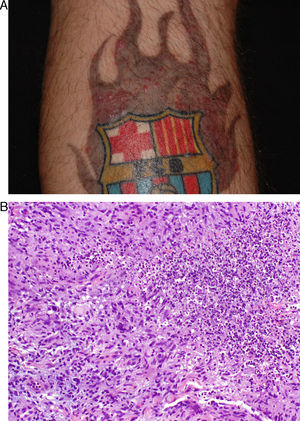 Caso 1. A. Pápulo-pústulas localizadas exclusivamente en la zona gris de la llamarada. B. Granuloma abscesificate con presencia de alguna célula gigante (hematoxilina-eosina x 200).
