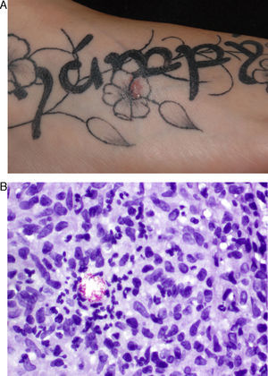 Caso 2. A. Lesión papulosa eritematosa en la zona gris de un pétalo de la flor. B. Cúmulo de bacilos ácido-alcohol resistentes en la zona de abscesificación (tinción de Kinyoun x 400).