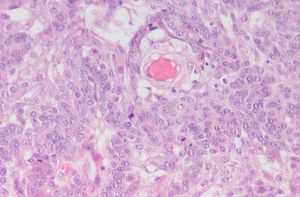 Células tumorales de pequeño tamaño y aspecto basaloide. Hematoxilina-eosina 40x.
