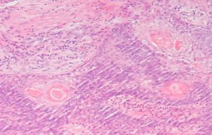 Imágenes glandulares con una sustancia eosinófila en su interior que constituye la secreción sebácea. Hematoxilina-eosina 40x.