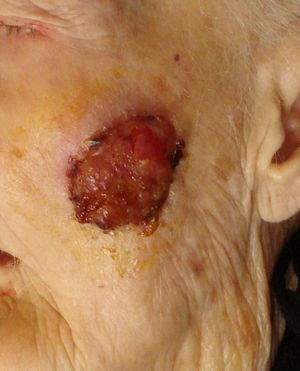 Tumoración exofítica ulcerada en la mejilla izquierda.
