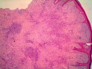 Vista panorámica donde se aprecia la lesión tumoral en la dermis y su invasión de los tejidos profundos (H-E x400).