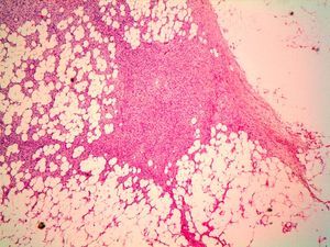 Células tumorales invadiendo el tejido adiposo, dejando islotes de adipocitos en su interior. (H-E x200).