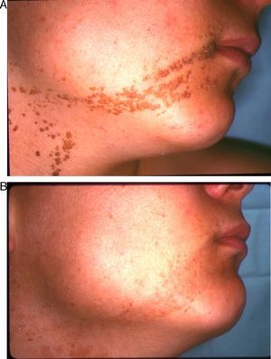 Nevo epidérmico en la cara (paciente 20). Antes (A) y después del tratamiento con láser de CO2 (B).
