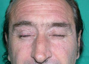 Placas eccematosas en la cara en un paciente de la industria eólica.