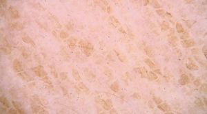 Microscopia de epiluminiscencia realizada con dermatoscopio digital de contacto empleando líquido de inmersión.