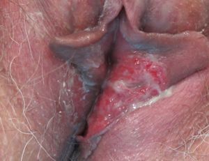 Ulceración del labio menor izquierdo con pseudomembranas blanquecinas en la superficie. La úlcera se extiende discretamente hacia el labio menor derecho.