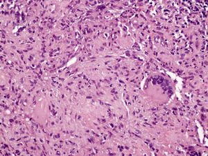 Histiocitos epiteliodes y célula tipo Langhans en el granuloma tuberculoide. Hematoxilina-eosina, x20.