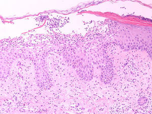 Pústula subcórnea con edema en la dermis papilar e infiltrado inflamatorio rico en neutrófilos. (Hematoxilina-eosina, x10 aumentos).