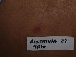 Positividad del parche a nistatina 2% en vaselina a las 96h.