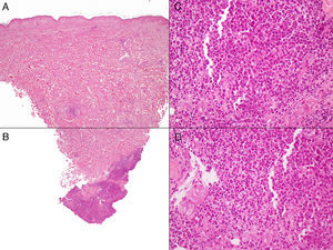 A la izquierda (A, B) se obseva imagen panorámica del segundo caso, con infiltrados inflamatorios linfocitarios escasos perivasculares en dermis superficial y media, y densos en dermis profunda. A la derecha (C, D) se aprecia detalle del infiltrado en la dermis profunda, donde se observan células redondeadas, de núcleos grandes con cromatina laxa, y abundantes mitosis, acompañados de linfocitos normales. (HE, A-B: x40, C-D: x400).