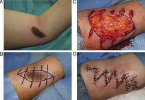 Plastia en Z múltiple para la extirpación de un nevus congénito situado en la flexura del codo.