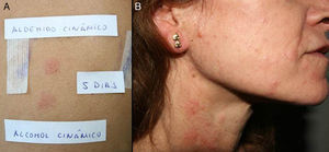 Dermatitis en la cara lateral de cuello, zona frecuente de afectación de dermatitis alérgica de contacto por fragancias por aplicación de perfumes y colonias. En el caso de esta paciente estaba sensibilizada a aldehído y alcohol cinámico.
