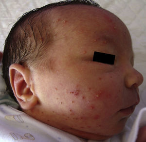 Múltiples vesículo-pústulas distribuidas por la frente, la mejilla, el cuello y el pabellón auricular.