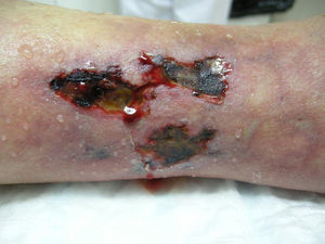 Úlceras necróticas sobre áreas livedoides en las piernas.