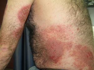 Placas eccematosas en el tronco y en los miembros superiores.