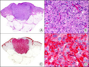 Carcinoma espinocelular. A. Visión panorámica (x10). B. Detalle de las células neoplásicas mostrando núcleos vesiculosos con nucléolo prominente y amplio citoplasma eosinófilo (x400). C. El mismo caso estudiado inmunohistoquímicamente con citoqueratina AE1/AE3. Obsérvese la positividad de la neoplasia, así como del epitelio de la epidermis y los anejos cutáneos de la dermis (x10). D. Detalle a gran aumento de la positividad de las células neoplásicas con la citoqueratina AE1/AE3 (x400).