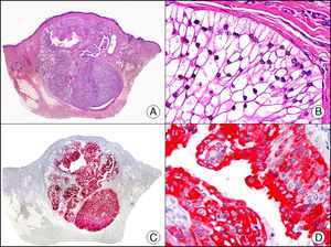 Hidradenoma apocrino de células claras. A. Visión panorámica (x10). B. Detalle a gran aumento de un agregado de células neoplásicas mostrando su morfología de células claras (x400). C. El mismo caso estudiado inmunohistoquímicamente con citoqueratina 8 (x10). D. Detalle de la positividad para citoqueratina 8 de las células neoplásicas (x400).