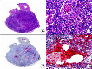 Carcinoma sebáceo. A. Visión panorámica (x10). B. A gran aumento se observan hallazgos indicativos de diferenciación sebácea en forma de sebocitos inmaduros y ductos sebáceos (x400). C. El mismo caso estudiado inmunohistoquímicamente con EMA. Obsérvese el control interno positivo de las glándulas sebáceas normales de la dermis (x10). D. Detalle de la positividad para el EMA en las áreas con diferenciación sebácea más evidente (x400).