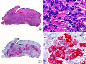 Carcinoma de células histiocitoides primario de párpado. A. Visión panorámica (x10). B. Detalle del aspecto histiocitoide de las células neoplásicas. Algunas células muestran vacuolización citoplasmática (x400). C. El mismo caso estudiado inmunohistoquímicamente con GCDFP-15 (x10). D. Detalle de la positividad para GCDFP-15 en las células neoplásicas (x400).