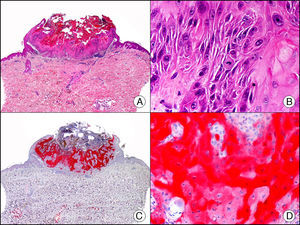 Queratoacantoma. A. Visión panorámica (x10). B. Detalle de las células neoplásicas (x400). C. El mismo caso estudiado inmunohistoquímicamente con calretinina (x10). D. Detalle a gran aumento de la positividad para calretinina en las células neoplásicas (x400).