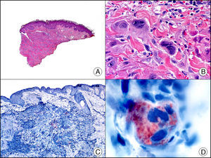 Metástasis cutánea de coriocarcinoma de testículo. A. Visión panorámica (x10). B. Detalle de las células de sincitiotrofoblasto (x400). C. El mismo caso estudiado inmunohistoquímicamente con beta-gonadotrofina coriónica (x40). D. Detalle de la positividad para beta-gonadotrofina coriónica en las células del sincitiotrofoblasto (x400).
