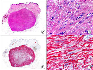 Angioleiomioma cutáneo. A. Visión panorámica (x10). B. Detalle a gran aumento de las células neoplásicas mostrando núcleo alargado de extremos romos y citoplasma eosinófilo (x400). C. El mismo caso estudiado inmunohistoquímicamente con desmina (x10). D. Detalle de la positividad de las células neoplásicas para la desmina (x400).
