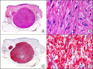 Angioleiomioma cutáneo. A. Visión panorámica (x10). B. Detalle a gran aumento de las células neoplásicas mostrando núcleo alargado de extremos romos y citoplasma eosinófilo (x400). C. El mismo caso estudiado inmunohistoquímicamente con caldesmón (x10). D. Detalle de la positividad de las células neoplásicas con caldesmón (x400).