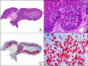 Enfermedad de Paget extramamaria. A. Visión panorámica (x10). B. Detalle mostrando numerosas células grandes y atípicas, de citoplasma amplio y basófilo, salpicadas como células aisladas en el espesor de la epidermis (x400). C. El mismo caso estudiado inmunohistoquímicamente con citoqueratina CAM 5.2 (x10). D. Positividad para la citoqueratina CAM5.2 de las células neoplásicas de la enfermedad de Paget extramamaria, mientras que los queratinocitos de la epidermis permanecen negativos (x400).