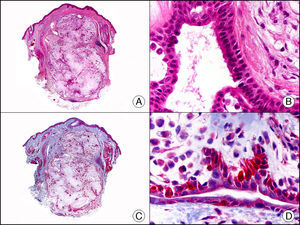 Tumor mixto apocrino. A. Visión panorámica (x10). B. Detalle a gran aumento de las estructuras ductales alargadas tapizadas por una doble hilera de células (x400). C. El mismo caso estudiado inmunohistoquímicamente con calponina (x10). D. Detalle de la positividad para calponina de las células de la hilera periférica que tapiza los ductos, apoyando su naturaleza mioepitelial (x400).