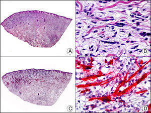 Rabdomiosarcoma cutáneo. A. Visión panorámica (x10). B. Detalle de las células neoplásicas mostrando un núcleo atípico, alargado e hipercromático (x400). C. El mismo caso estudiado inmunohistoquímicamente con MyoD (x10). D. Detalle de la positividad de las células neoplásicas con MyoD (x400).