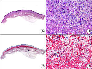 Fibroma dérmico en placa. A. Visión panorámica mostrando una lesión con infiltración horizontal de la dermis superficial (x10). B. A gran aumento se observa que la lesión está constituida por células fusiformes dispuestas en remolinos alrededor de los vasos (x200). C. El mismo caso estudiado inmunohistoquímicamente con CD34 (x10). D. Detalle de la positividad para el CD34 de las células neoplásicas (x200).