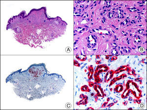 Hemangioma capilar lobulillar. A. Visión panorámica (x10). B. Detalle de los capilares tapizados por células endoteliales que constituyen la lesión (x400). C. El mismo caso estudiado inmunohistoquímicamente con WT1 (x10). D. Detalle de la positividad para el WT1 en el núcleo de las células endoteliales proliferantes (x400).
