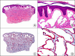 Malformación linfática superficial. A. Visión panorámica (x10). B. Detalle de los vasos dilatados de pared fina y tapizados por una hilera discontinua de células endoteliales aplanadas que ocupan la dermis superficial (x200). C. El mismo caso estudiado inmunohistoquímicamente con podoplanina (x10). D. Detalle de la positividad para la podoplanina en el citoplasma de las células endoteliales (x200).