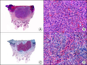 Sarcoma de Kaposi en fase nodular. A. Visión panorámica (x10). B. A mayor aumento se observan fascículos de células fusiformes y pequeños espacios vasculares ocupados por hematíes (x200). C. El mismo caso estudiado inmunohistoquímicamente con Lyve-1 (x10). D. Positividad para el Lyve-1 en las células neoplásicas (x200).