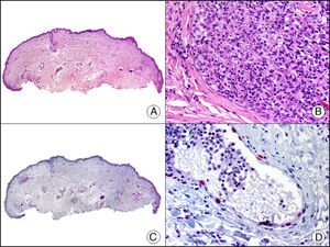 Histiocitosis intralinfática. A. Visión panorámica (x10). B. A mayor aumento se observan agregados de histiocitos intravasculares (x200). C. El mismo caso estudiado inmunohistoquímicamente con Prox-1 (x10). D. A mayor aumento se observa que los núcleos de las células que tapizan los vasos que contienen histiocitos expresan Prox-1, lo que demuestra su naturaleza linfática (x200).