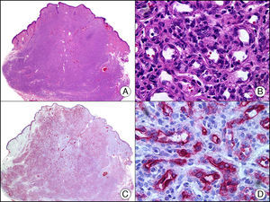 Hemangioma infantil. A. Visión panorámica (x10). B. Detalle a gran aumento de las células endoteliales proliferantes (x400). C. El mismo caso estudiado inmunohistoquímicamente con Glut-1 (x10). D. Detalle de la positividad para el Glut-1 de las células endoteliales tapizando las luces de los capilares neoformados (x400).
